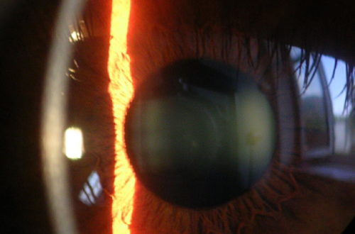 Cornea Slitlamp
