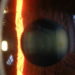 Cornea Slitlamp